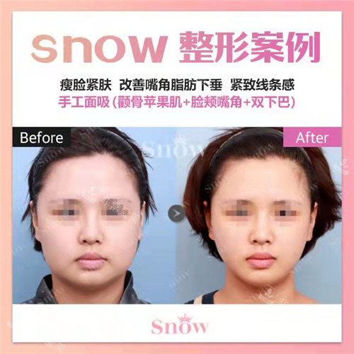 韩国SNOW整形外科面吸是对比照