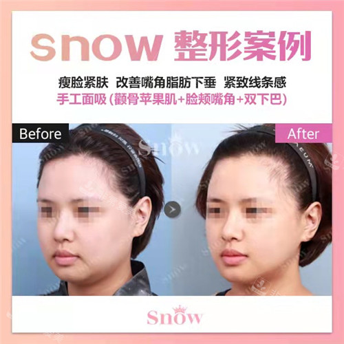 韩国SNOW整形外科面吸手术对比