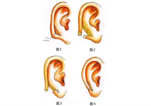 郭树忠再造耳效果怎么样-费用多少-挂号预约，详细攻略！