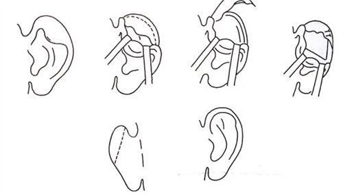耳畸形矫正流程图