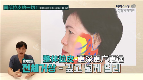 大拉皮手術提升范圍