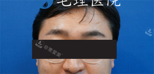 做眉毛移植后照片 做眉毛移植后照片