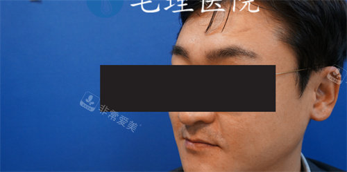 做眉毛移植后照片 做眉毛移植后照片