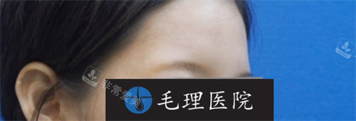 眉毛移植術(shù)前照片 眉毛移植術(shù)前照片