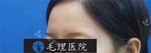 眉毛移植術(shù)前照片 眉毛移植術(shù)前照片
