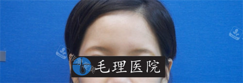 眉毛移植術(shù)前照片 眉毛移植術(shù)前照片