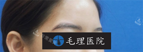 眉毛移植術(shù)后照片 眉毛移植術(shù)后照片