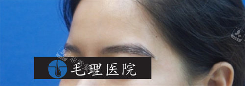 眉毛移植術(shù)后照片 眉毛移植術(shù)后照片