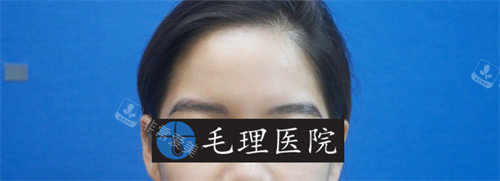 眉毛移植術(shù)后照片 眉毛移植術(shù)后照片