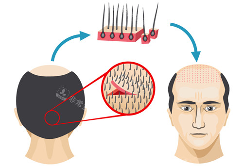 毛发移植过程图