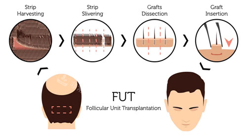 植发过程图