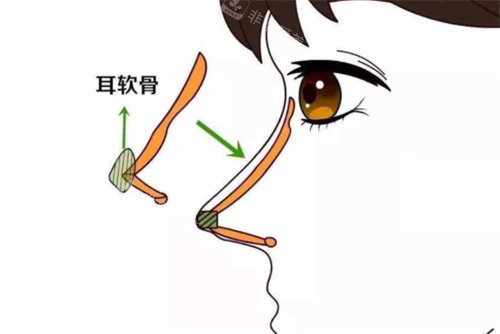 耳軟骨隆鼻動畫圖
