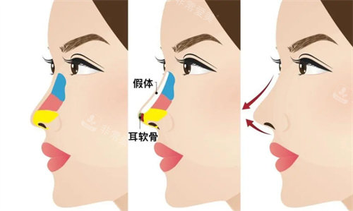 復(fù)合隆鼻動畫演示圖