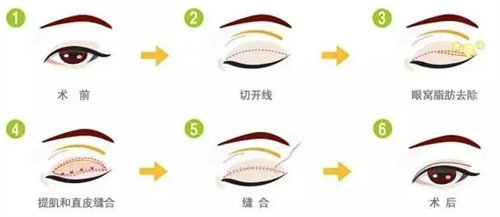 雙眼皮手術(shù)過(guò)程圖 雙眼皮手術(shù)過(guò)程圖