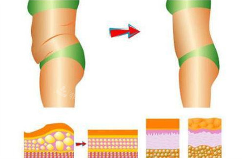 腰腹吸脂前后对比图