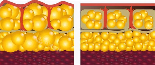 脂肪肿胀前后对比图
