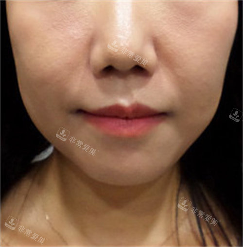 埋線提升術前照片 埋線提升術前照片