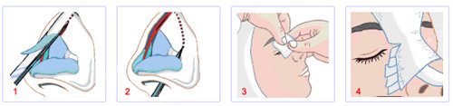 隆鼻手术流程图