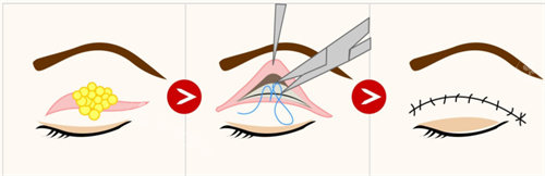 切开双眼皮流程图