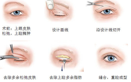 切开法双眼皮