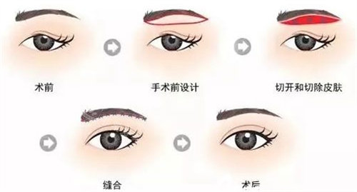 提眉手術(shù)圖