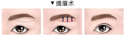提眉術(shù)