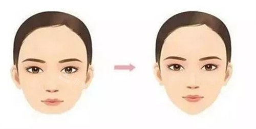 下巴手術(shù)前后對(duì)比圖 下巴手術(shù)前后對(duì)比圖