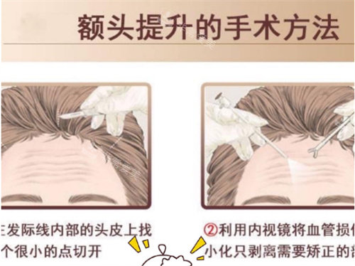內(nèi)窺鏡額頭提升術(shù)方法 內(nèi)窺鏡額頭提升術(shù)方法