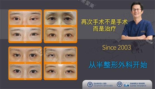 韩国世美整形眼修复怎么样?朴相炫修复双眼皮出名,附对比照