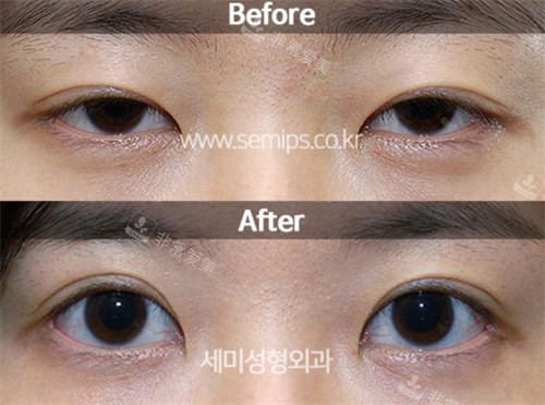 韩国世美整形外科眼修复对比图
