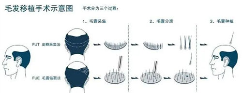 毛發(fā)移植術(shù)圖 毛發(fā)移植術(shù)圖