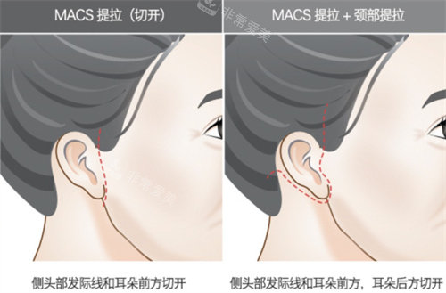 韩国格瑞丝噢爱美整形外科拉皮手术