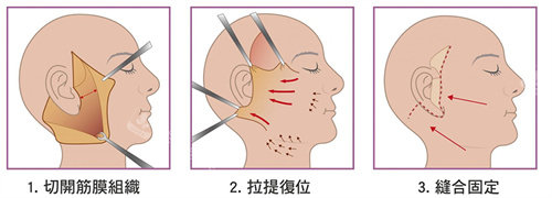 面部拉皮手术流程图