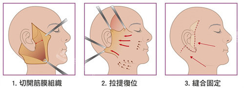 面部拉皮手術(shù)流程圖