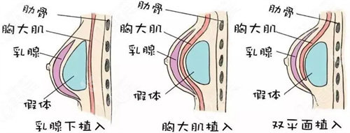 隆胸植入圖