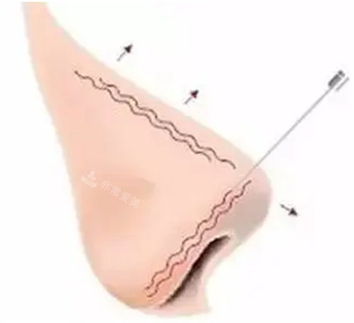 隆鼻手术图
