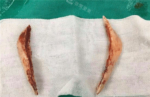 削掉的下頜骨照片 削掉的下頜骨照片