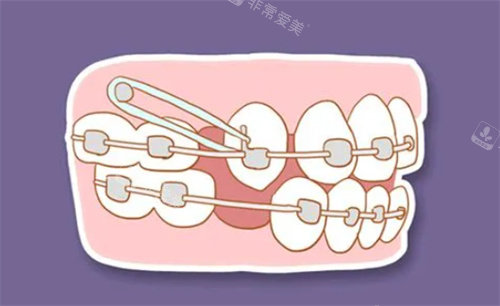 牙齿矫正动画展示图