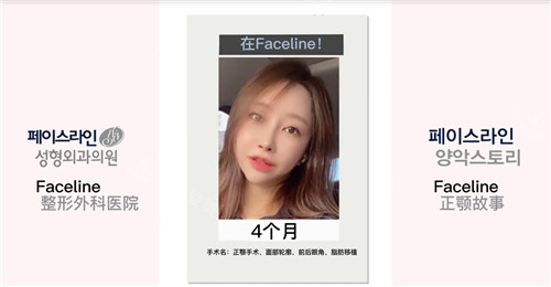 菲斯萊茵Faceline整形正顎手術(shù)術(shù)后 菲斯萊茵Faceline整形正顎手術(shù)術(shù)后