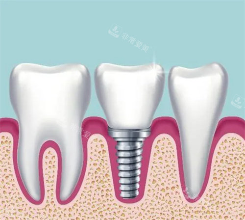 种植牙展示图