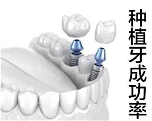 种植牙图片