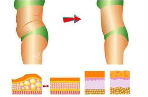 吸脂瘦腰腹动画展示图