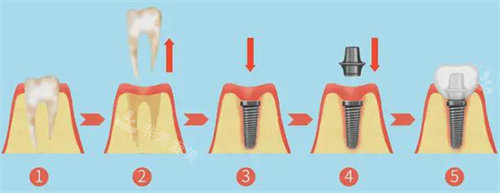 种植牙全过程图
