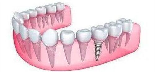 种植牙图片