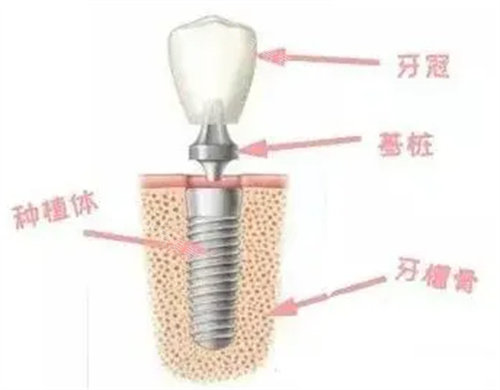 种植牙展示图