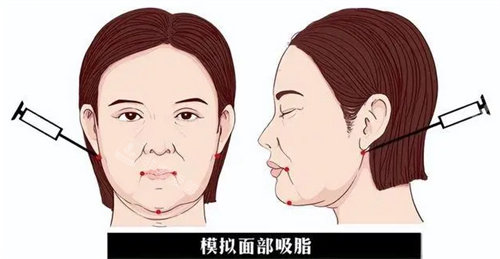 模擬面部吸脂圖