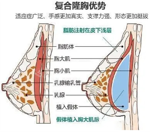 假体隆胸结构图