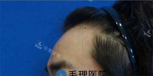 發(fā)際線植發(fā)前圖片 發(fā)際線植發(fā)前圖片