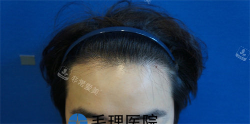 發(fā)際線植發(fā)前圖片 發(fā)際線植發(fā)前圖片