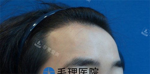 發(fā)際線植發(fā)前圖片 發(fā)際線植發(fā)前圖片